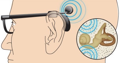 Aides auditives à conduction osseuse, implants d'oreille moyenne